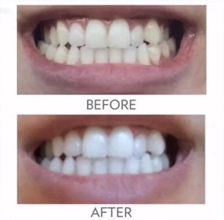 whitening_toothpaste